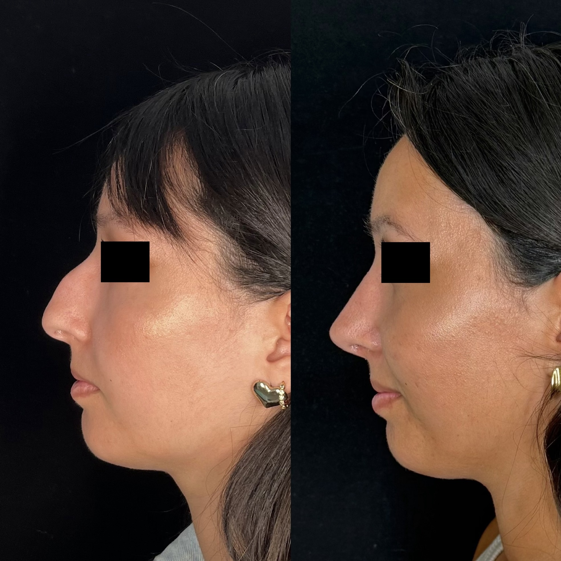 Caso clínico de rinoplastia 1